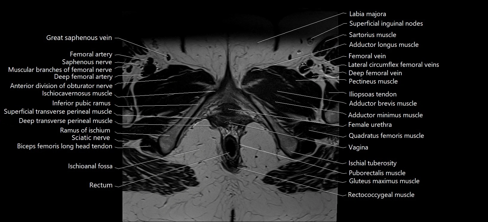 Axial cross sectional anatomy of female pelvis (MRI 3T) image 41.webp